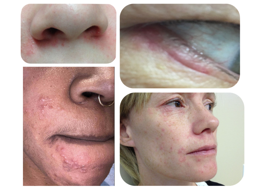 Perioral Rash In Children Perioral Dermatitis - rockiesdermatology.com